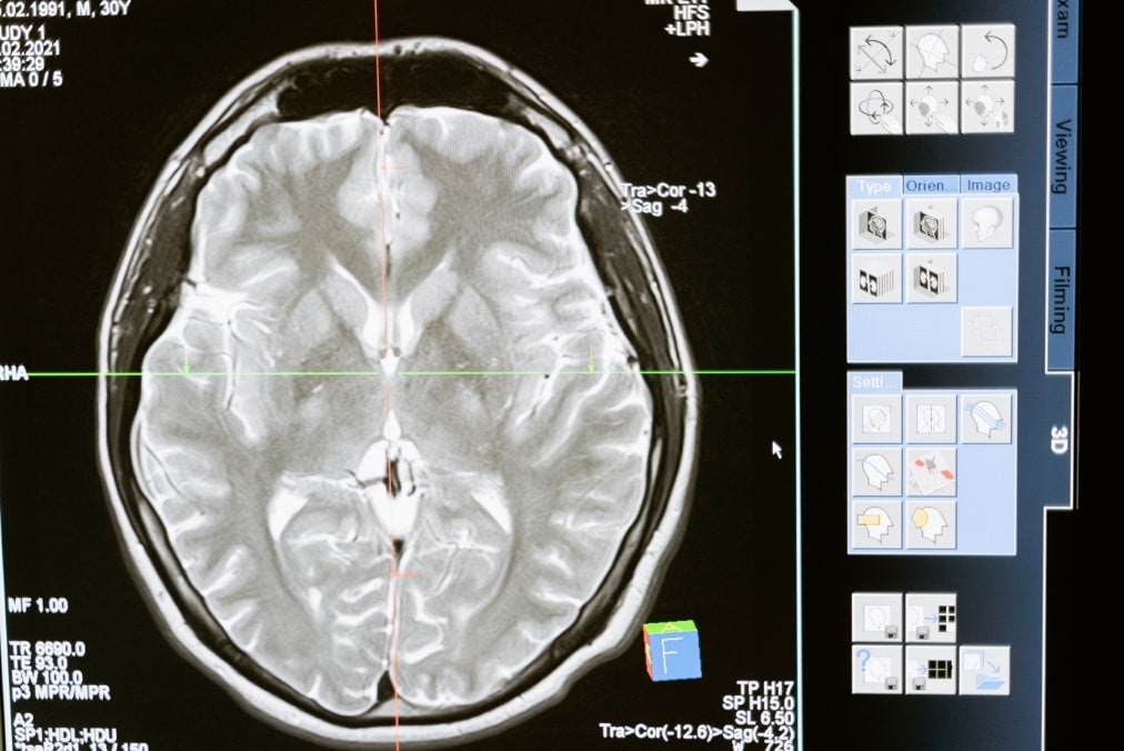 Should I Accept a Traumatic Brain Injury Settlement?