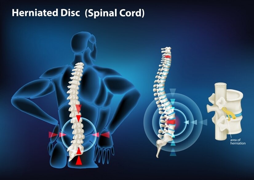 Degenerative Disc Disease After Car Accident Settlement in Nevada