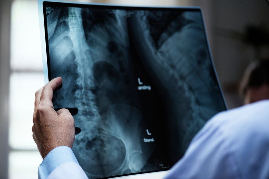 Scoliosis After a Car Accident: Navigating the Path to Fair Scoliosis Car Accident Settlement