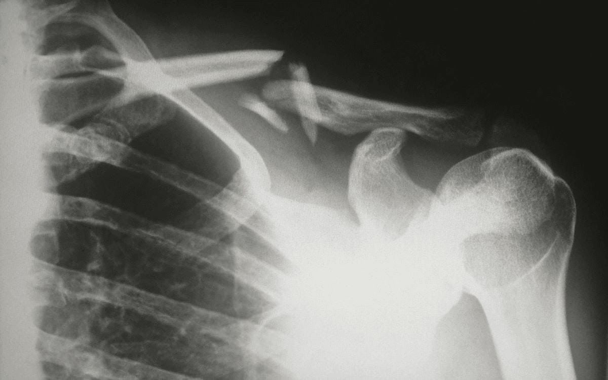 Understanding the Average Settlement for Broken Clavicle Cases in Nevada