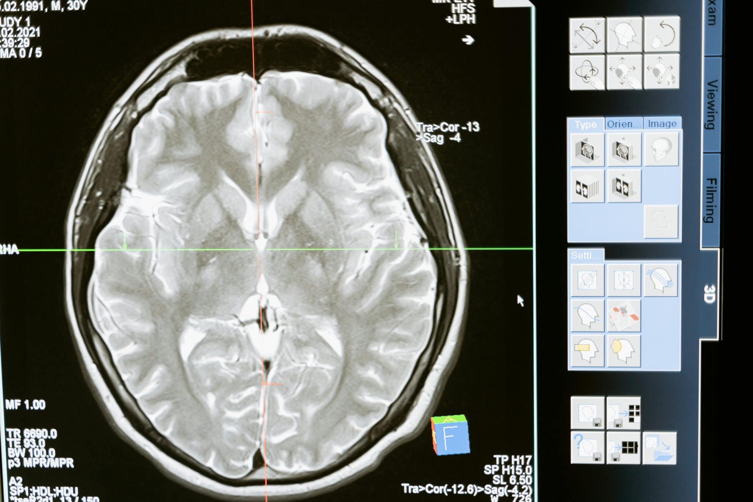 Brain X-ray used as evidence in a brain injury lawsuit.