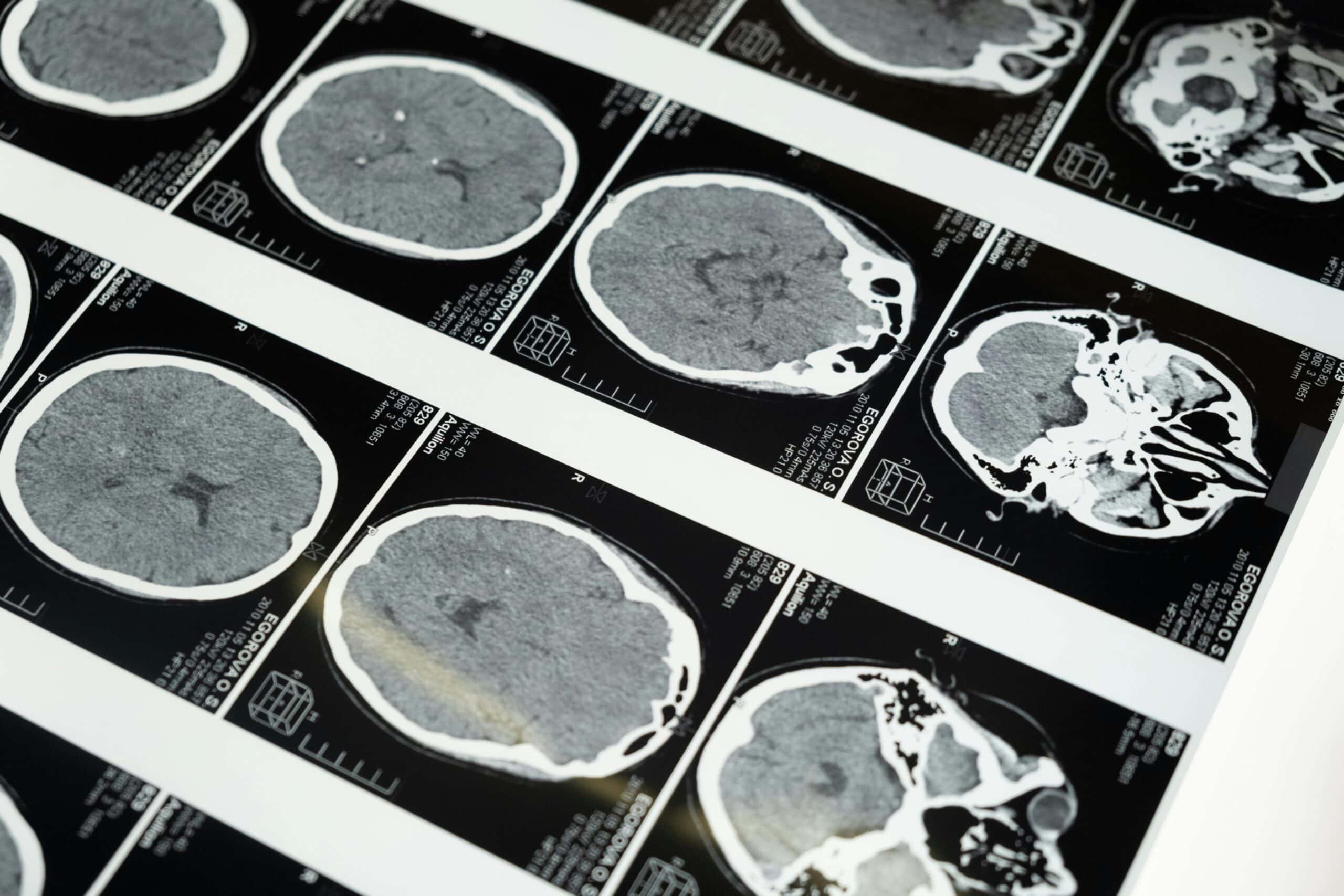 A brain scan as evidence in brain injury lawsuits.